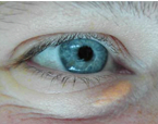 Xanthelasma